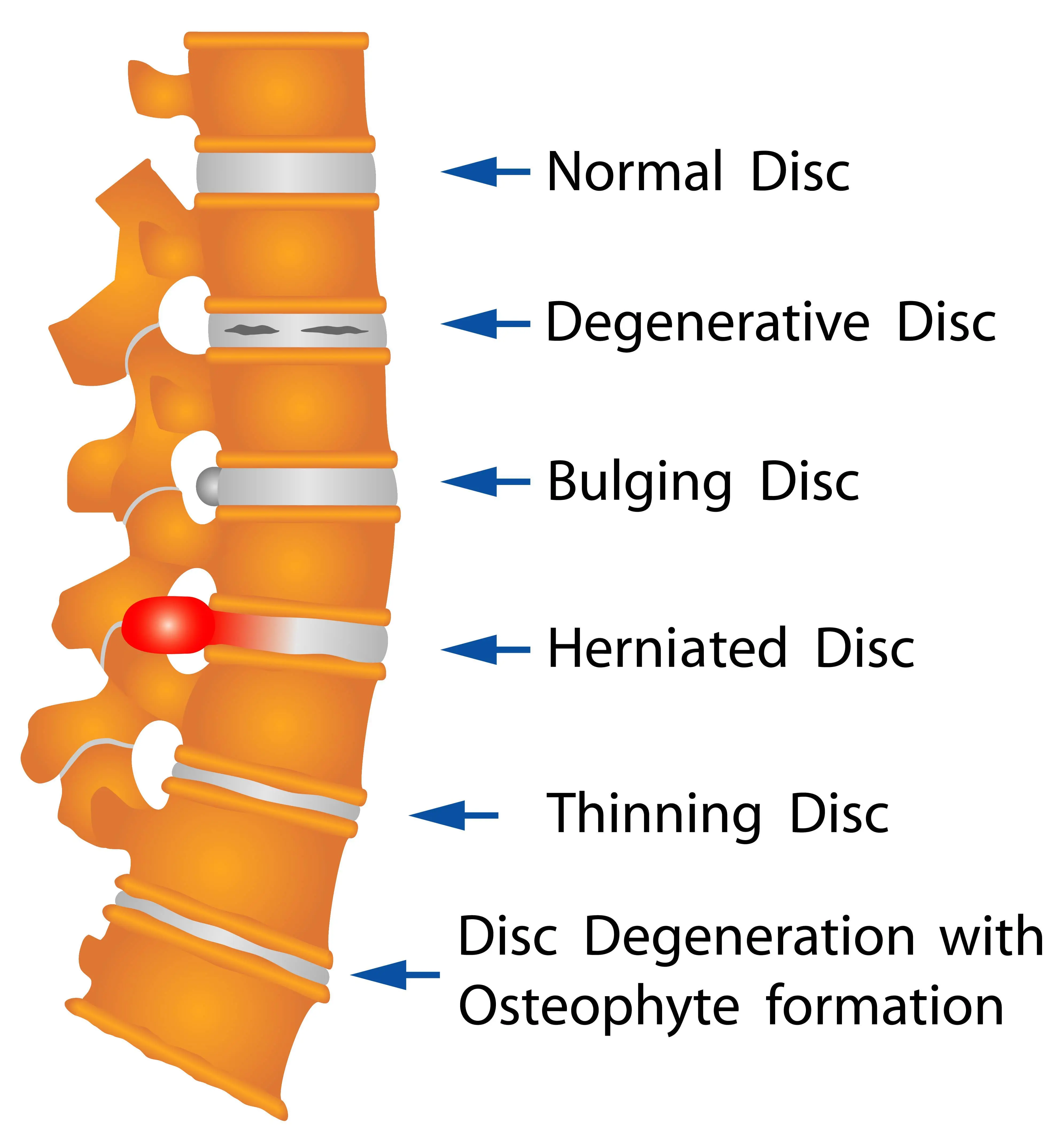 Chiropractor in Burbank Dr. Shahen shows a diagram of disc disorders