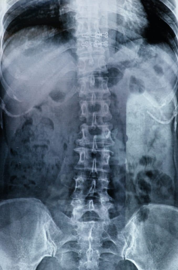 x-ray image of patients spine