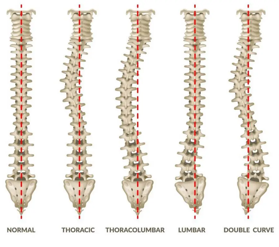 Scoliosis types 