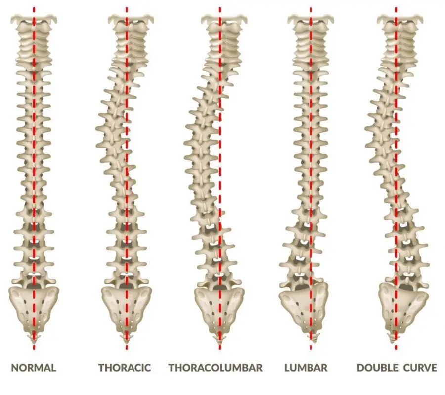 Scoliosis types