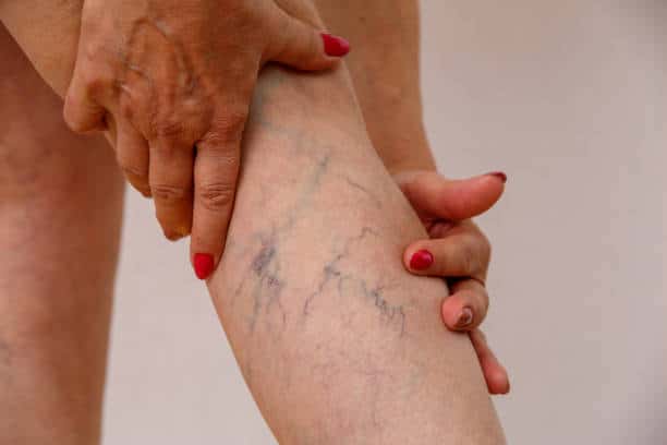varicose veins of elderly woman.