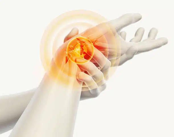 3D medical illustration of a hand with Carpal tunnel syndrome